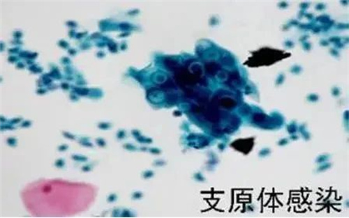 警惕慢性子宫内膜炎，别让好孕溜走！