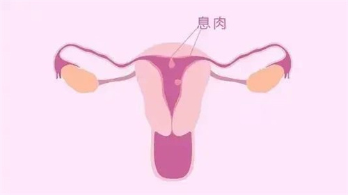 警惕慢性子宫内膜炎，别让好孕溜走！