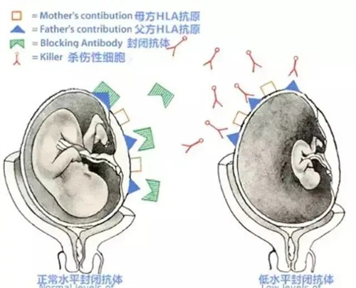 做试管婴儿为什么还会复发性流产？别忘了查封闭抗体！