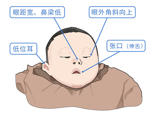 世界唐氏综合征日| 第三代试管婴儿技术，为新生命护航！