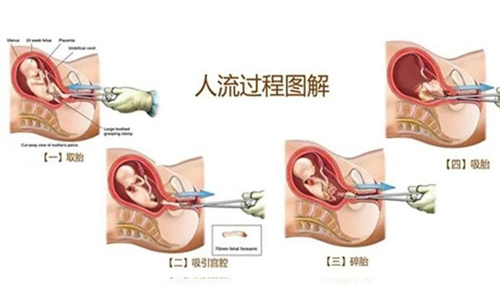 内膜薄的实用治疗方法，总有一种适合你！