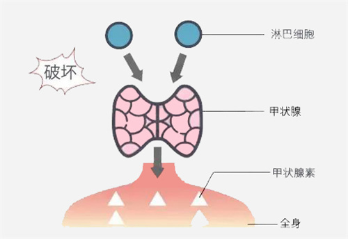 反复流产，久备不孕？病因竟在脖子上！