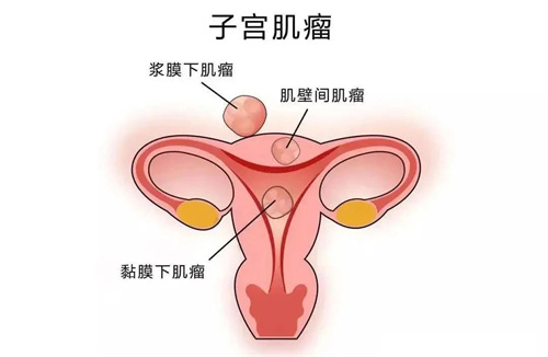 发现子宫肌瘤，选择做手术还是试管助孕？