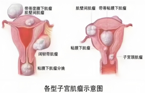 发现子宫肌瘤，选择做手术还是试管助孕？