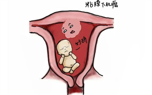 发现子宫肌瘤，选择做手术还是试管助孕？