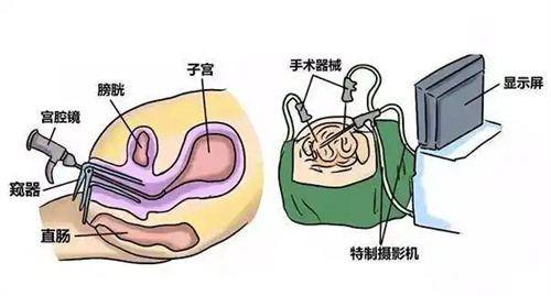 宫腹腔镜术后“好孕+防复发”双攻略！手把手教你避开90%人踩过的坑！