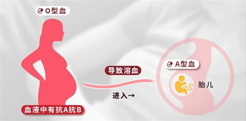 血型不合的隐形危机：新生儿溶血的科学预防指南