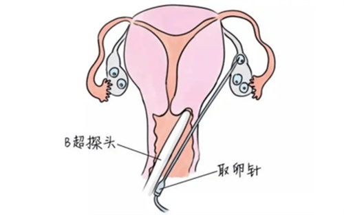 试管婴儿100问合集（三）