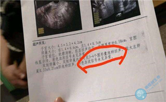 做试管婴儿流程前为什么要查窦卵泡？