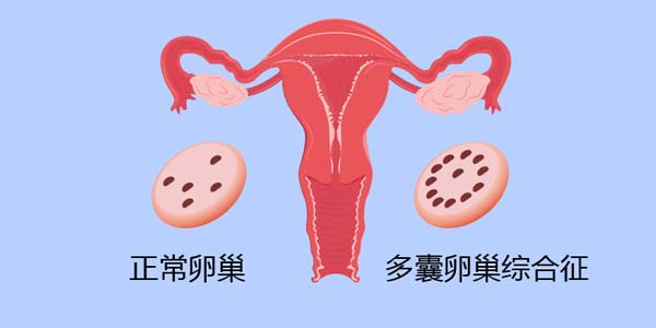 试管婴儿医生：详解多囊卵巢综合征