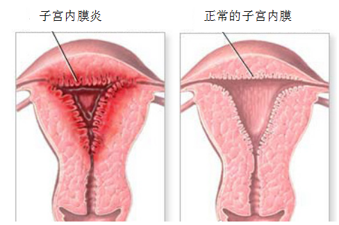 宫腔镜子宫内膜炎图片图片
