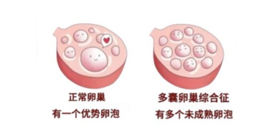 试管备孕姐妹注意！DHEA吃错会影响卵泡发育