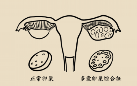 试管备孕屡次失败?应警惕胰岛素抵抗! 试管备孕屡次失败?应警惕胰岛素抵抗!