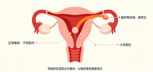 做试管婴儿，胚胎移植后会在子宫游离多久才着床？