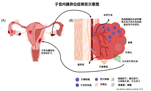 快来看看你属于哪种类型的子宫内膜异位症！
